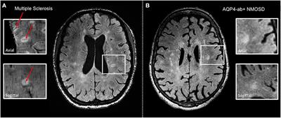 Visualizing the Central Nervous System: Imaging Tools for Multiple Sclerosis and Neuromyelitis Optica Spectrum Disorders